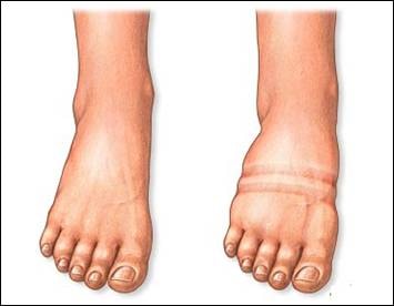 Phù do thuốc hạ huyết áp