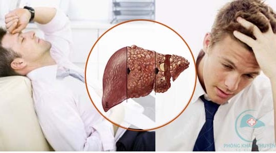 Việt Nam trong nhóm có tỷ lệ nhiễm virus viêm gan cao